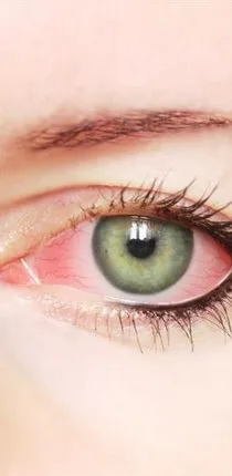 Göz kanlanması nasıl geçer? - Sağlık Haberleri